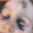Nana Sophia Axelsens dreng var et af de børn, der er blev udsat for overfald af andre børn i Fussingø Naturbørnehave. Nu lukke børnehaven helt. Privatfoto