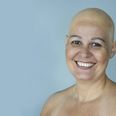Nabila har tabt alt sit hår men har alligevel valgt den lyse tilgang til livet. Pressefoto